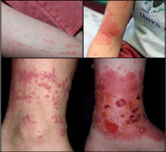 Poison Ivy Oak Sumac rash pictures